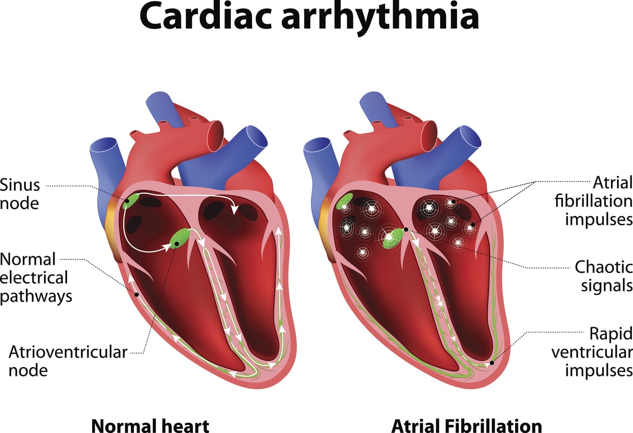 Cardiac Arrhythmia South Denver Cardiology   IStock A Fib 