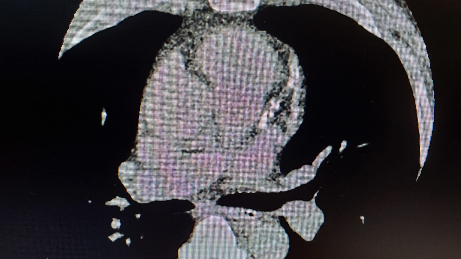 what-is-a-normal-calcium-heart-score-range-s-denver-cardiology