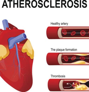 diagram of coronary calcification (atherosclerosis)