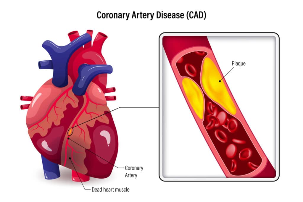diagram of coronary artery disease