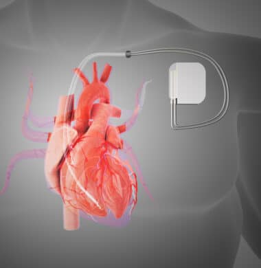 pacemaker - cardiology device