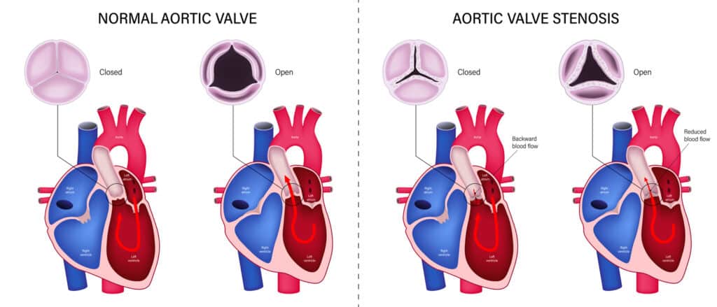 aortic valve stenosis