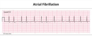 treatments for atrial fibrillation