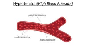 illustration showing the impact of high blood pressure on arteries
