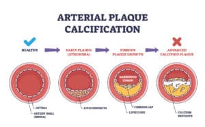 illustration of arteries in various stages of calcification/plaque buildup
