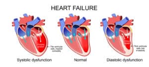 heart failure illustration