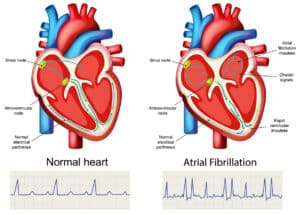 illustration with a Comparison of Normal Heart and Atrial Fibrillation