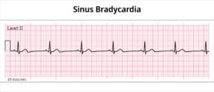 Illustration of bradycardia on ECG